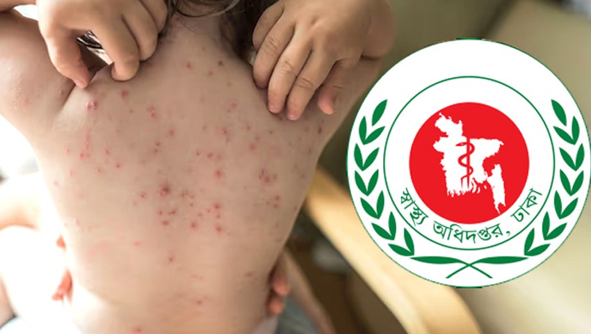 হাম ও উপসর্গে ২৪ ঘণ্টায় ৫ মৃত্যু, শনাক্ত ১ হাজার ২০